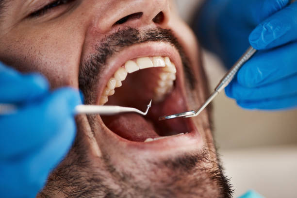Best Emergency Dental Care for Broken or Chipped Teeth in Churchville, NY