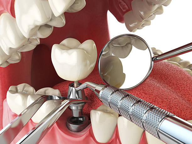 Best Urgent Care for Lost Fillings or Crowns in Churchville, NY